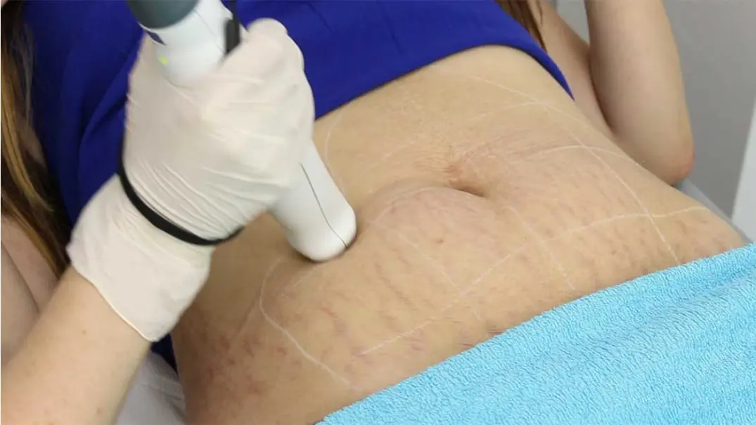 tratamento de estrias