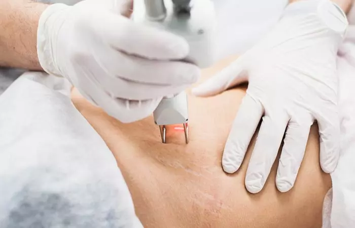 Tratamento de estrias