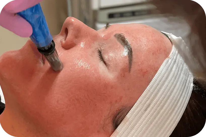 Tratamento com Microagulhamento