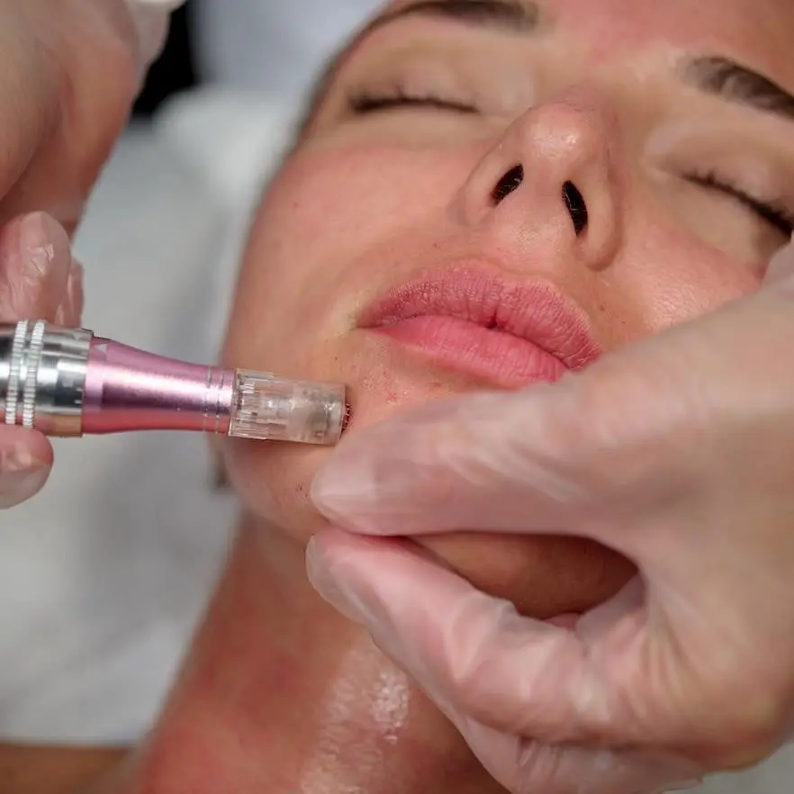 Tratamento com Microagulhamento