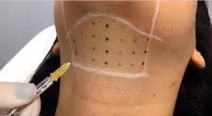 Preenchedor de Gluteo